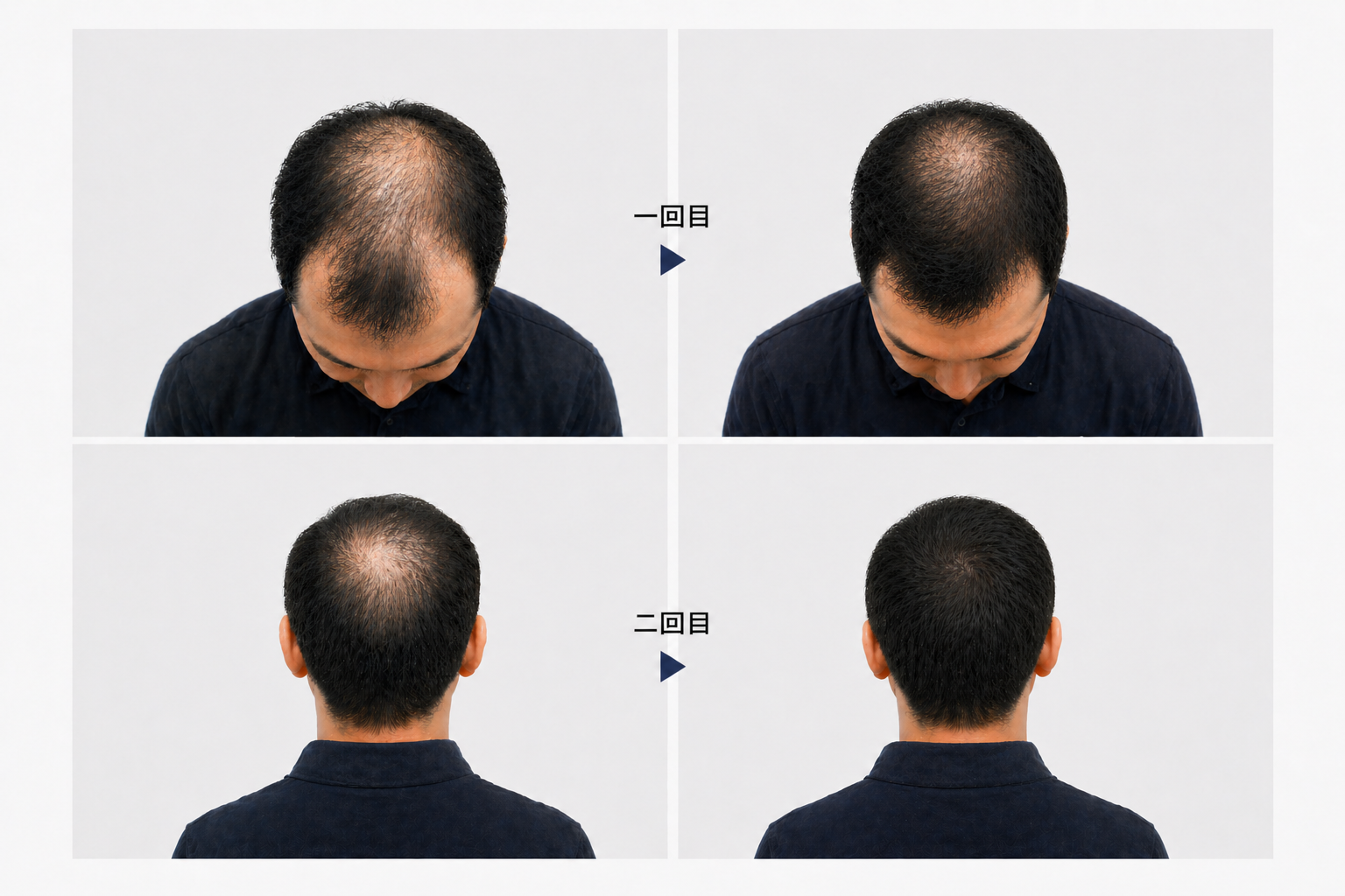 2回目植毛が必要になるケースとは？再手術を検討する理由と成功のポイント
