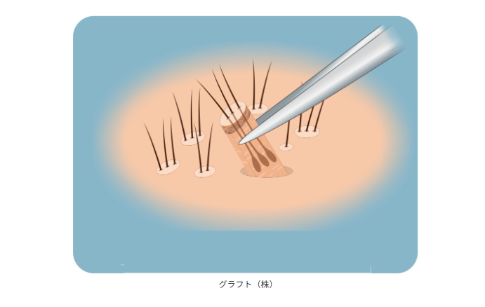 貴方は植毛手術に適した候補者ですか？
