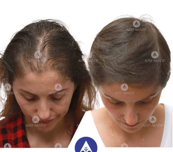 日本と海外の植毛の違い