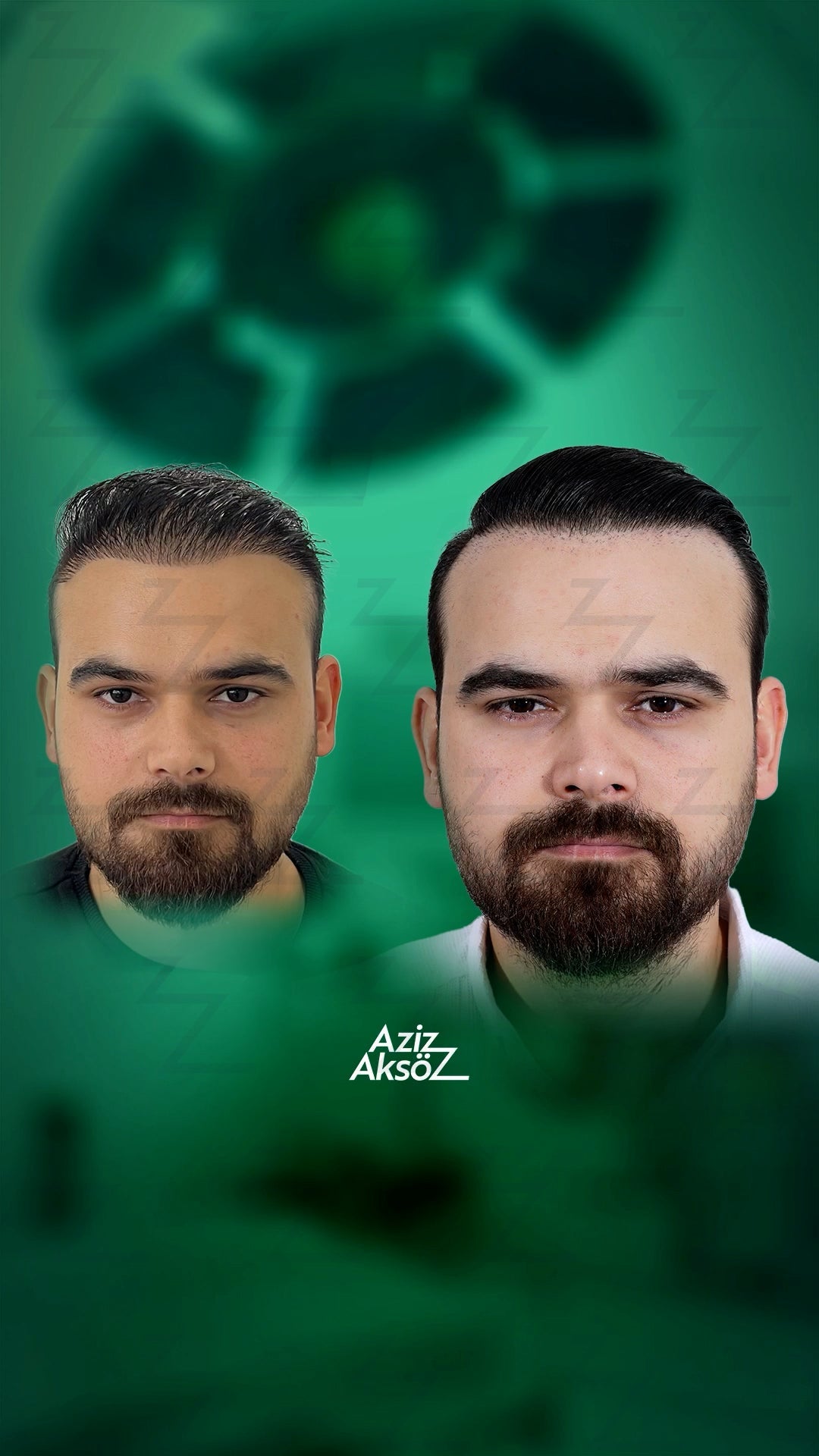 修正植毛が難しい理由とは？失敗を繰り返さないために知っておくべきポイント