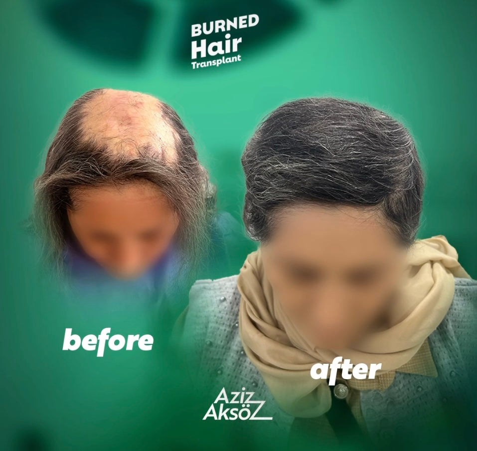 熱傷後の頭皮への植毛は可能？