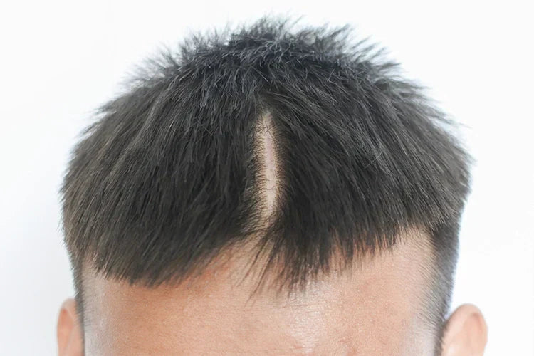 傷跡に植毛はできるのか？