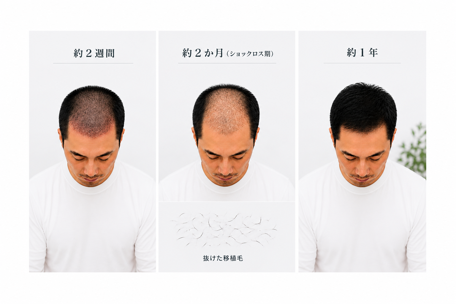 植毛後のショックロスとは？知っておきたい回復までの流れ
